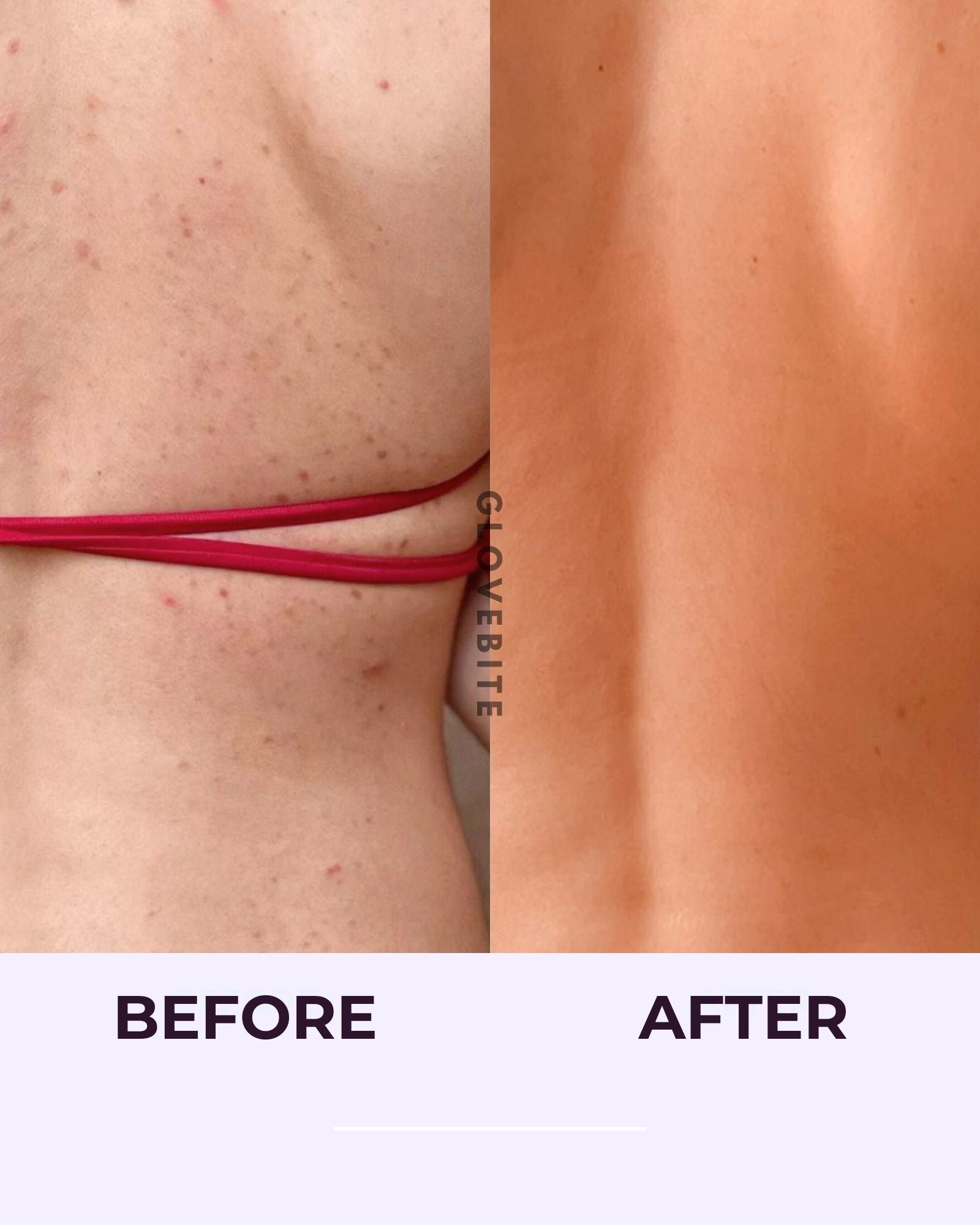 Before and After Glovebite Body acne improvement, even texture, reduce scarring, prevent breakouts